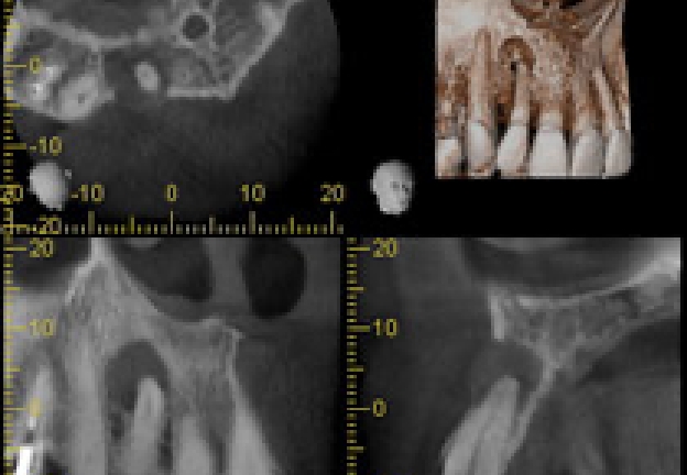 歯科用CT撮影+診断