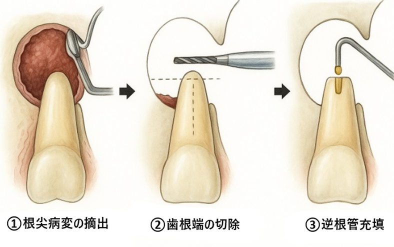 歯根端切除術
