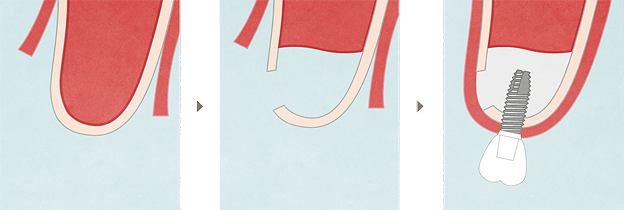 サイナスリフト